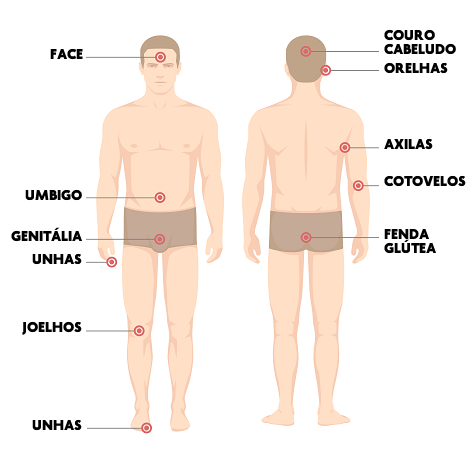 Principais Locais da Psoríase